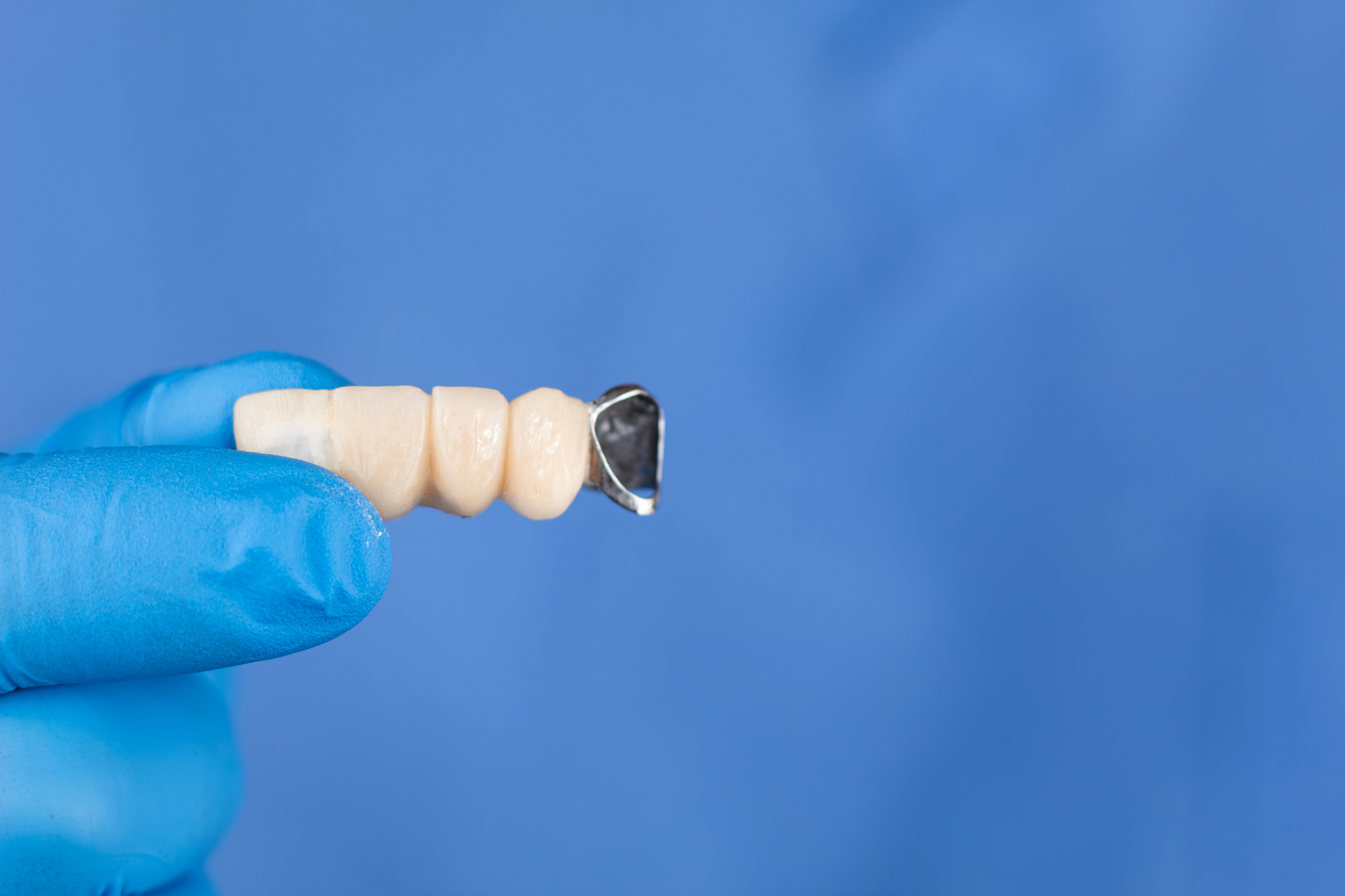 Additional Maryland wing dental bridge add-on